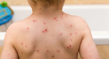 Mostaru i HNŽ-u prijeti epidemija morbila
