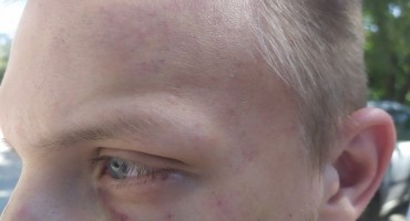 Turist iz Mađarske brutalno pretučen u Mostaru