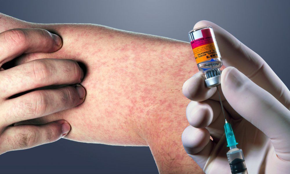 Epidemija ospica u Hrvatskoj
