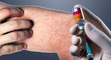 epidemija ospica