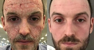 atopijski dermatitis, liječenje