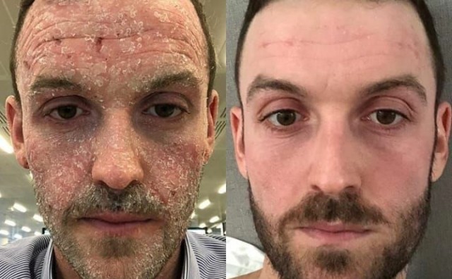 Atopijski dermatitis: Muškarac tvrdi da mu je prestanak korištenja steroidnih krema spasio kožu