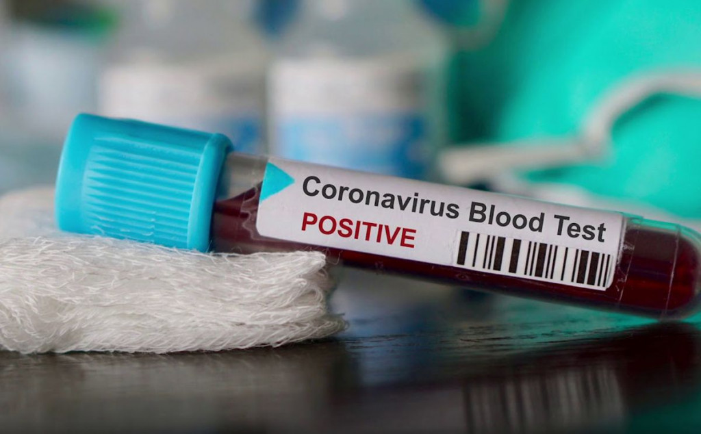 UZORAK POSLAN U NJEMAČKU Kod mladića iz Osijeka koronavirus ipak nije isključen
