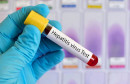 Hepatitis epruveta