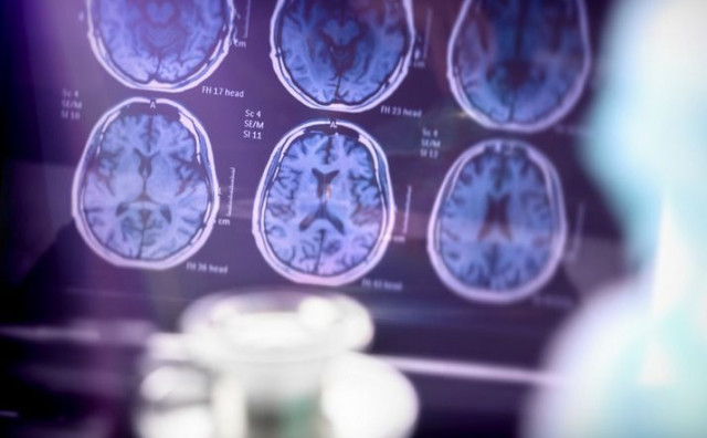 NOVA ERA PRED NAMA Novi lijek za Alzheimera drastično usporava bolest