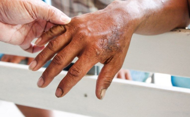 U Hrvatskoj potvrđen izolirani slučaj gube