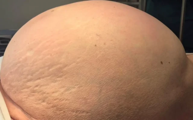 U Gospiću uklonjen tumor težak 36 kilograma: 81-godišnja pacijentica uspješno operirana