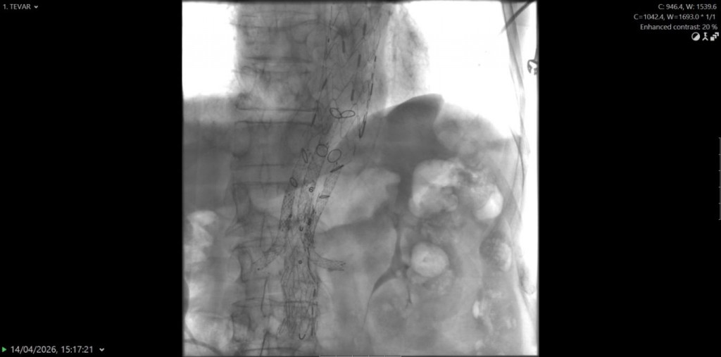 U SKB Mostar izveden BEVAR zahvat