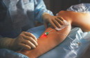 laserska kirurgija Vitalis